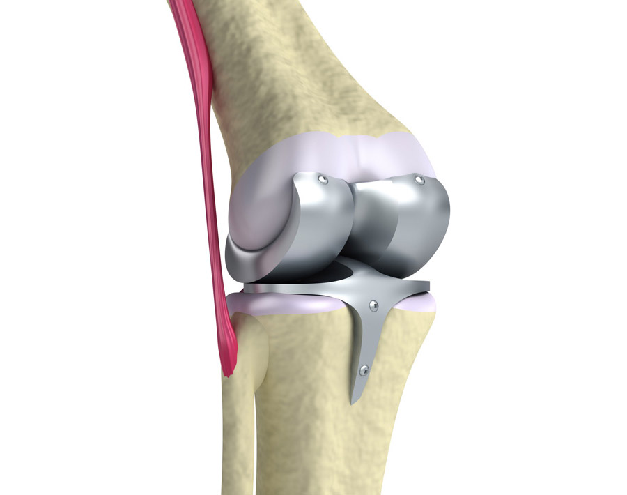 Pessoas com artrose avançada no joelho